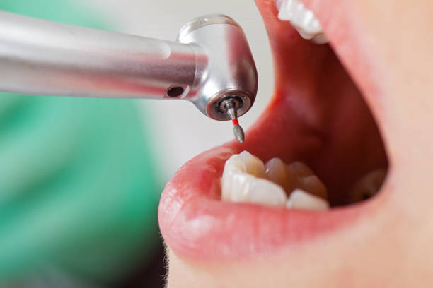 Best Knocked-Out Tooth (Avulsed Tooth) Treatment in Bremen, OH